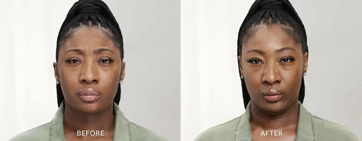 Botox-before-and-after-Laser-Center-and-MediSpa-3