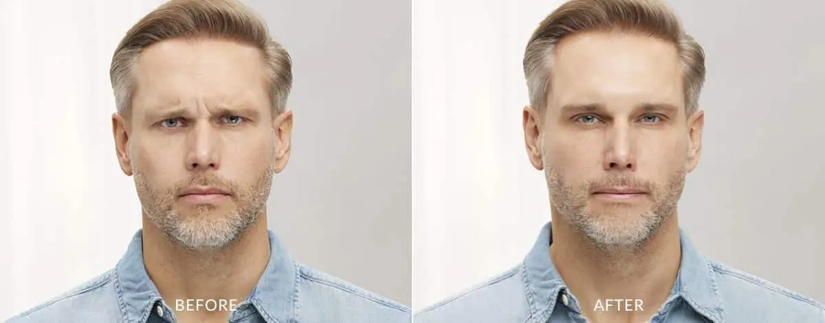 Botox-before-and-after-Laser-Center-and-MediSpa-4