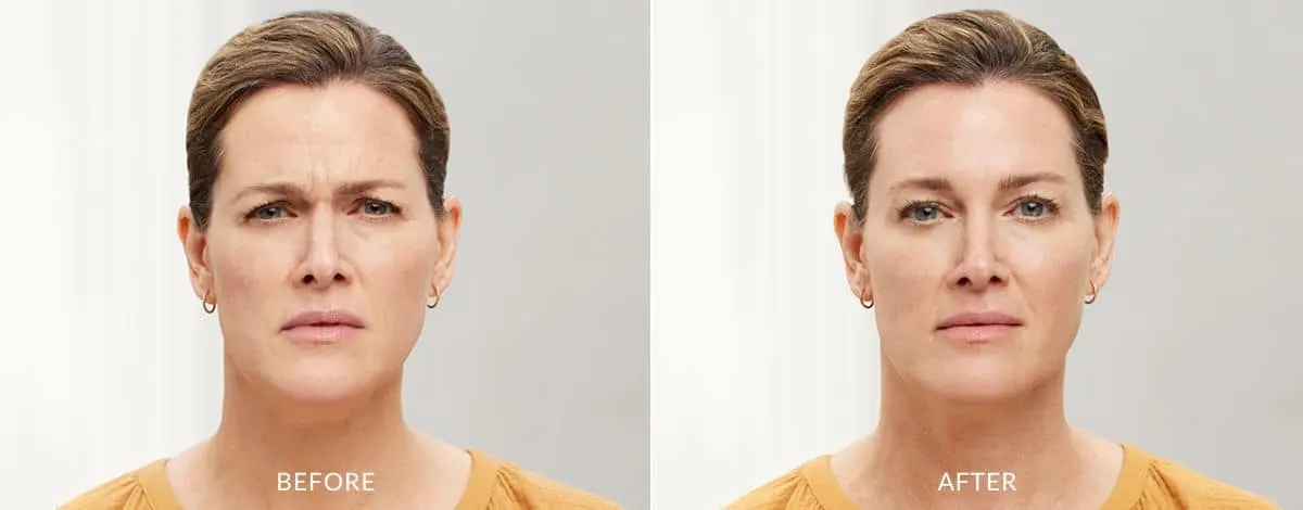Botox-before-and-after-Laser-Center-and-MediSpa-5