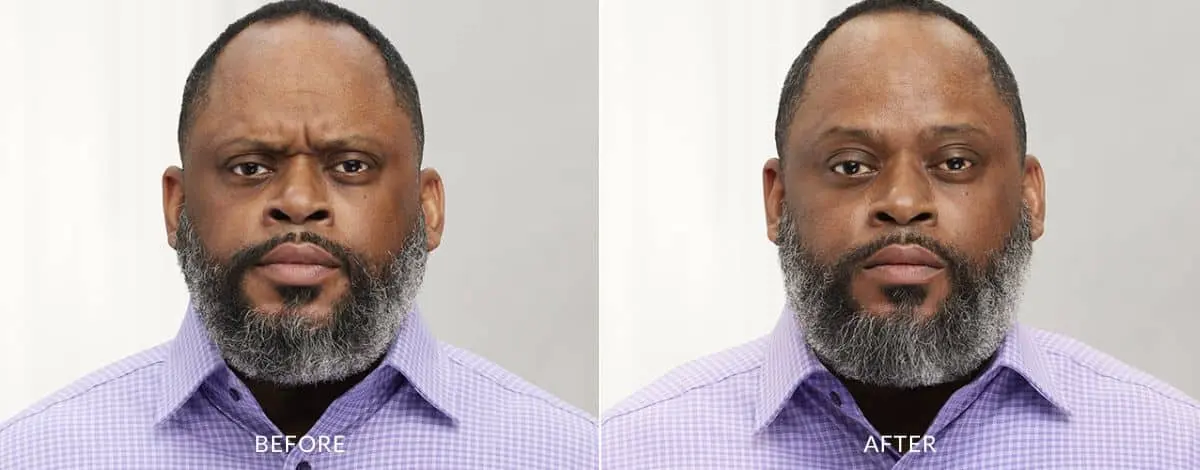 Botox-before-and-after-Laser-Center-and-MediSpa-6