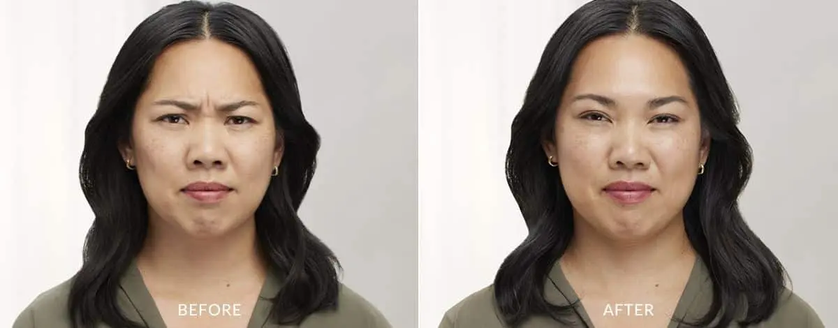 Botox-before-and-after-Laser-Center-and-MediSpa-7