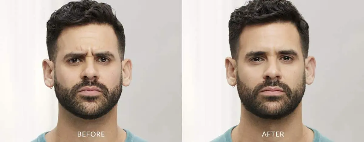 Botox-before-and-after-Laser-Center-and-MediSpa-8