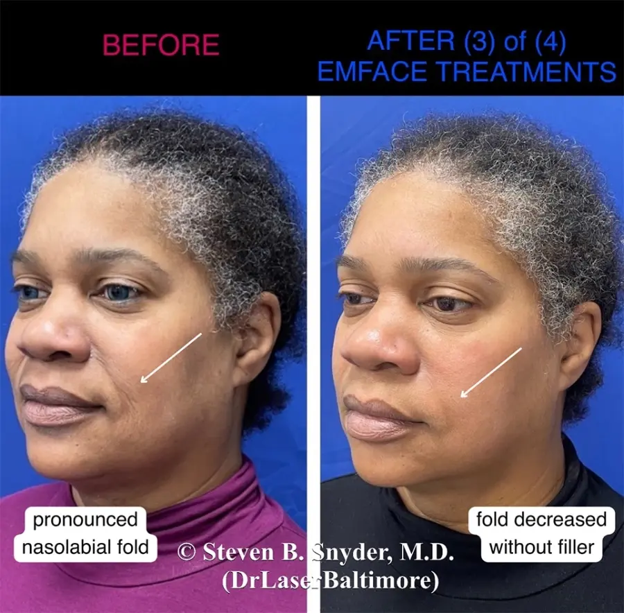 Emface-Dermatology-Laser-Center-and-Medispa-Owings-Mills-MD-before-and-after-02