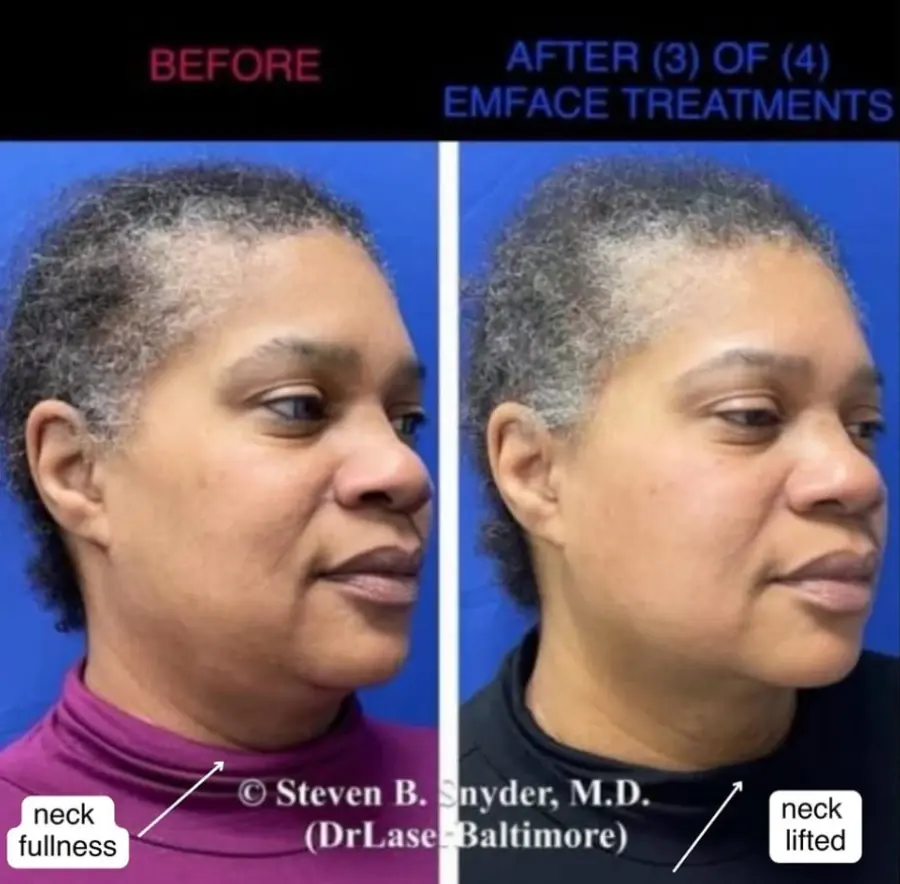 Emface-Dermatology-Laser-Center-and-Medispa-Owings-Mills-MD-before-and-after-03