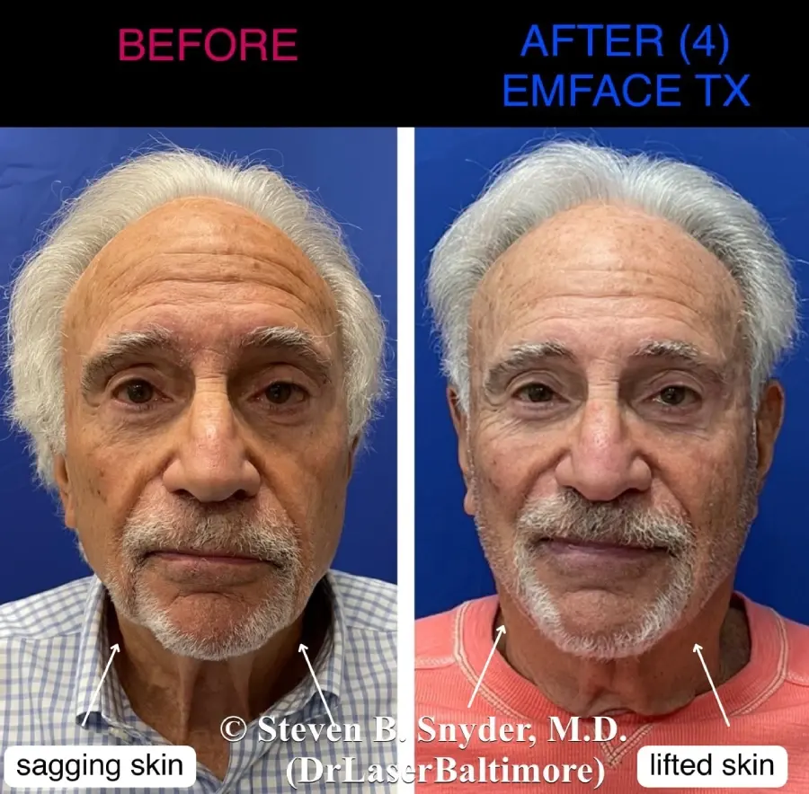 Emface-Dermatology-Laser-Center-and-Medispa-Owings-Mills-MD-before-and-after-05-2