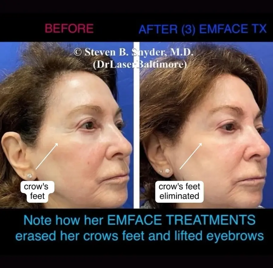 Emface-Dermatology-Laser-Center-and-Medispa-Owings-Mills-MD-before-and-after-05