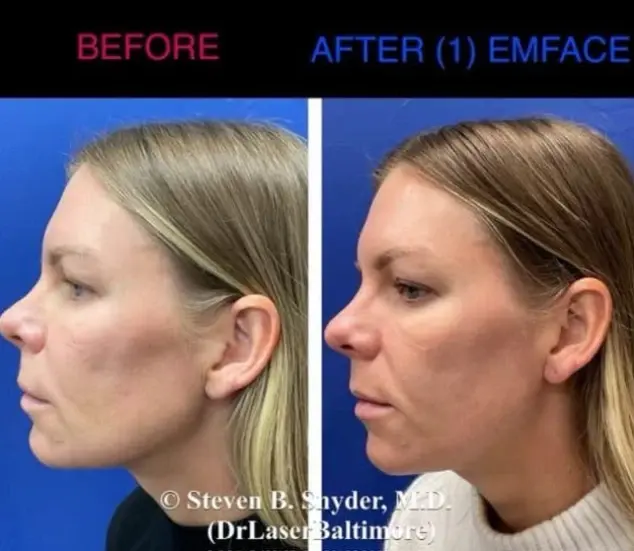 Emface-Dermatology-Laser-Center-and-Medispa-Owings-Mills-MD-before-and-after-06