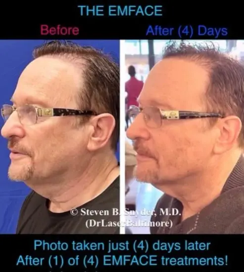 Emface-Dermatology-Laser-Center-and-Medispa-Owings-Mills-MD-before-and-after-7