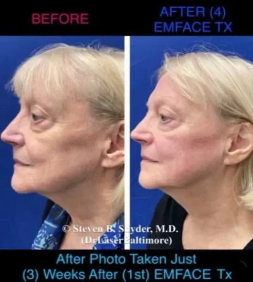 Emface-Dermatology-Laser-Center-and-Medispa-Owings-Mills-MD-before-and-after-8