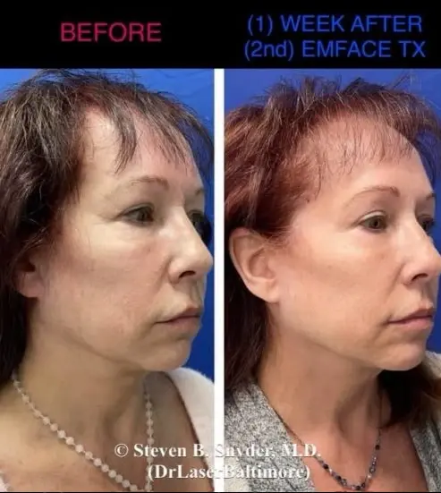 Emface-Dermatology-Laser-Center-and-Medispa-Owings-Mills-MD-before-and-after-9