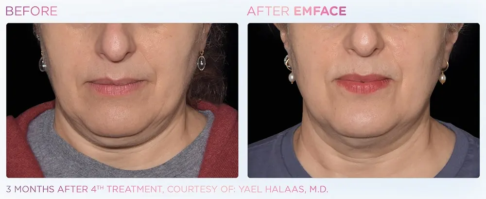 Emface_submentum_before_and_after