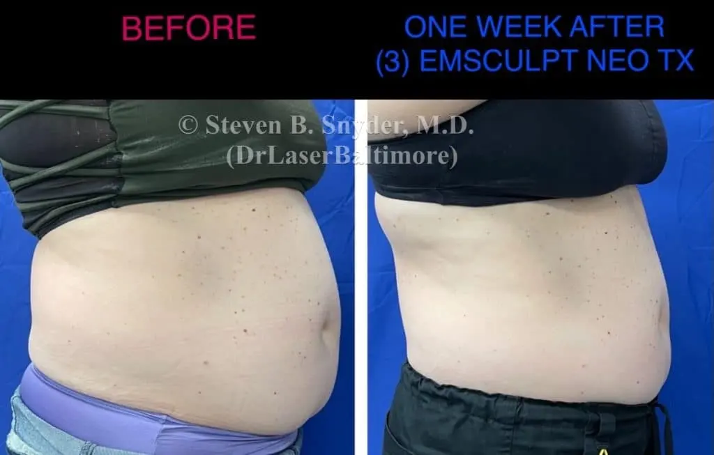 Emsculpt before and after results at Dermatology Laser Center & Medispa, Owings Mills, MD