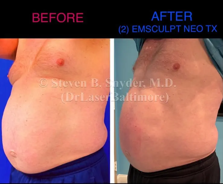 Emsculpt before and after results at Dermatology Laser Center & Medispa, Owings Mills, MD