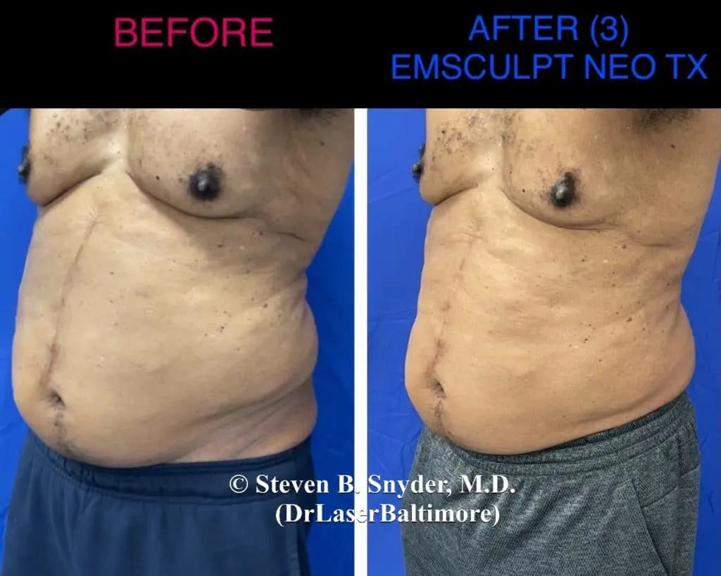 Emsculpt before and after results at Dermatology Laser Center & Medispa, Owings Mills, MD