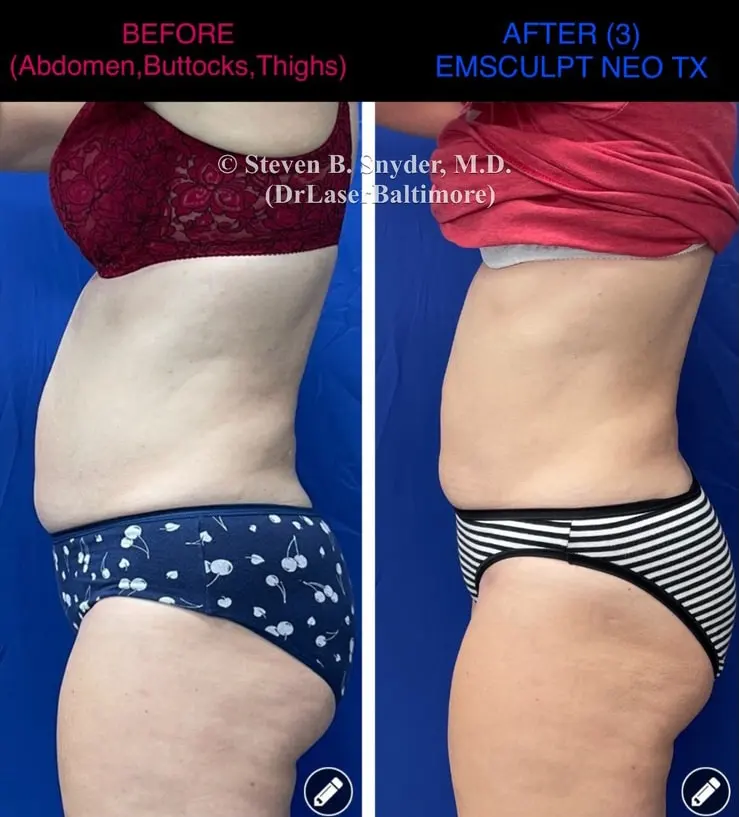 Emsculpt before and after results at Dermatology Laser Center & Medispa, Owings Mills, MD