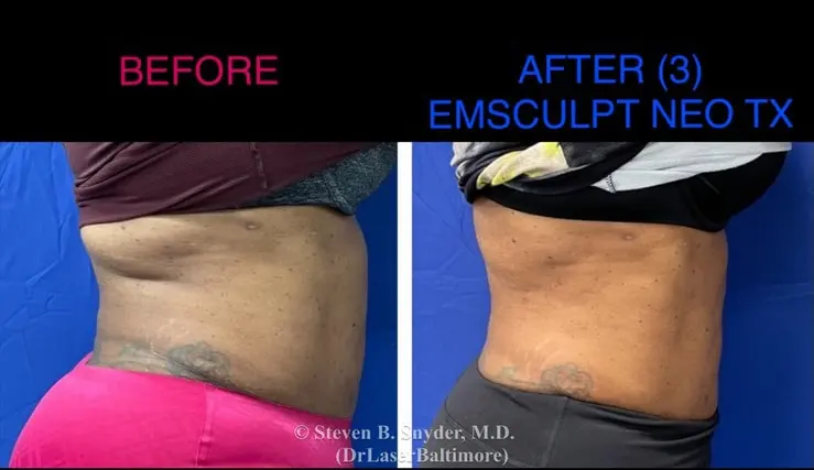 Emsculpt before and after results at Dermatology Laser Center & Medispa, Owings Mills, MD