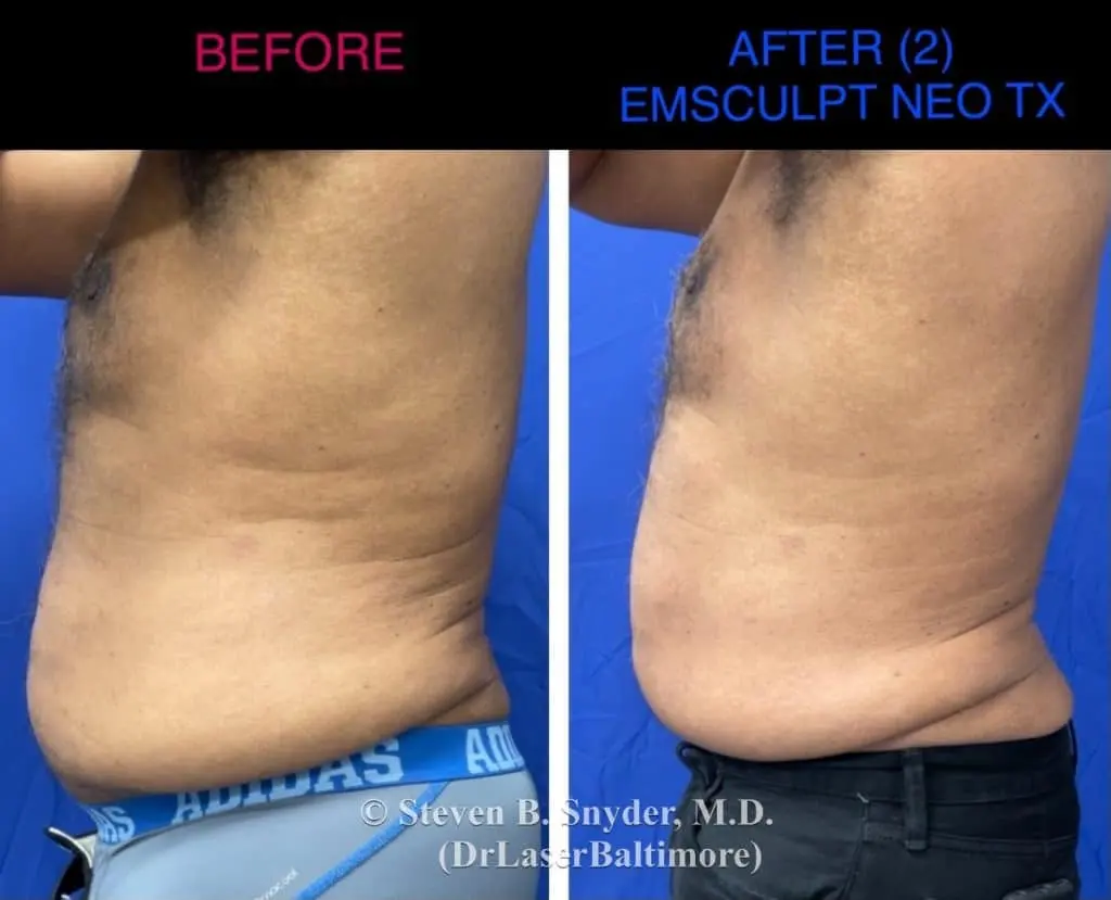 Emsculpt before and after results at Dermatology Laser Center & Medispa, Owings Mills, MD