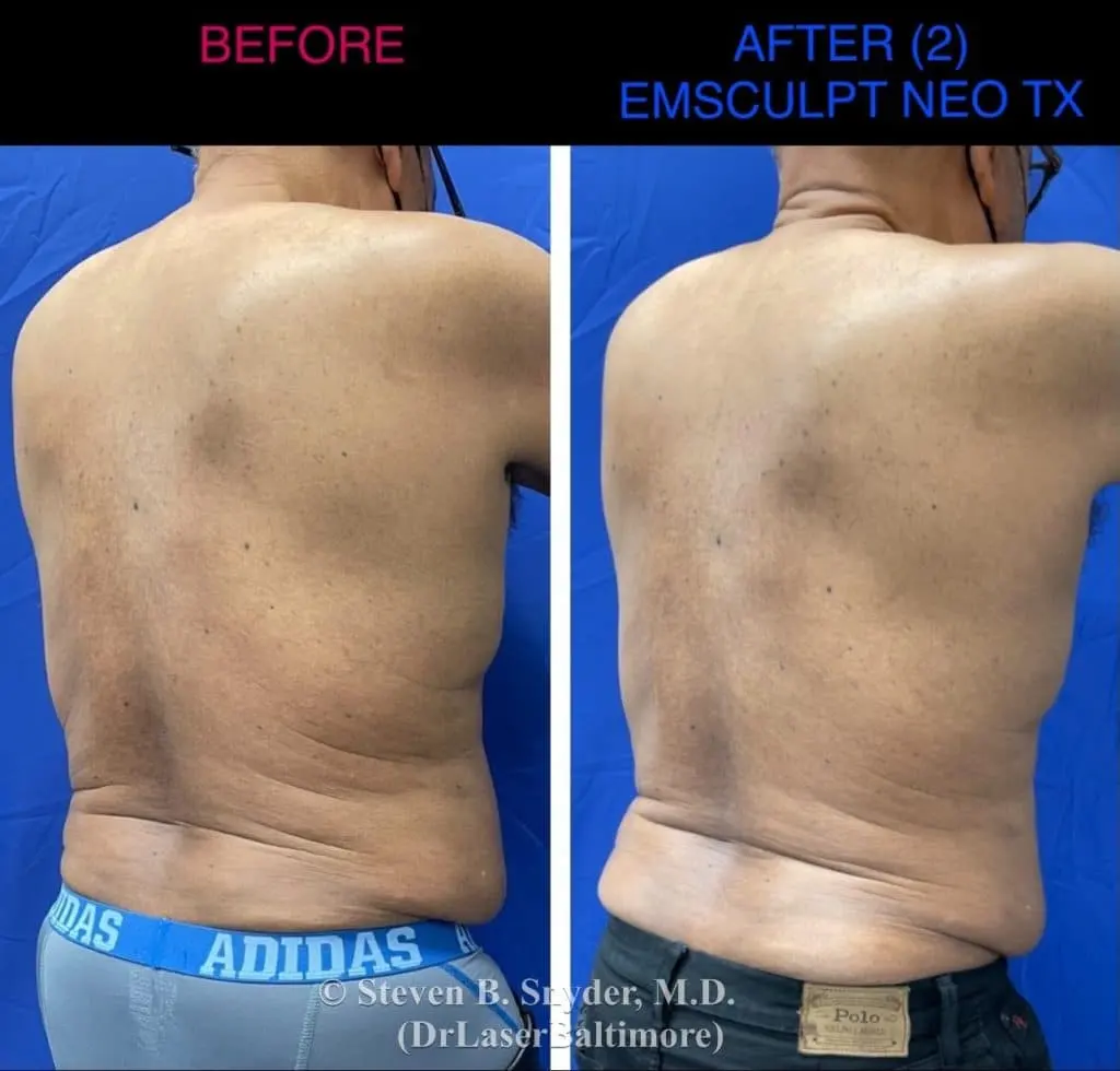 Emsculpt before and after results at Dermatology Laser Center & Medispa, Owings Mills, MD
