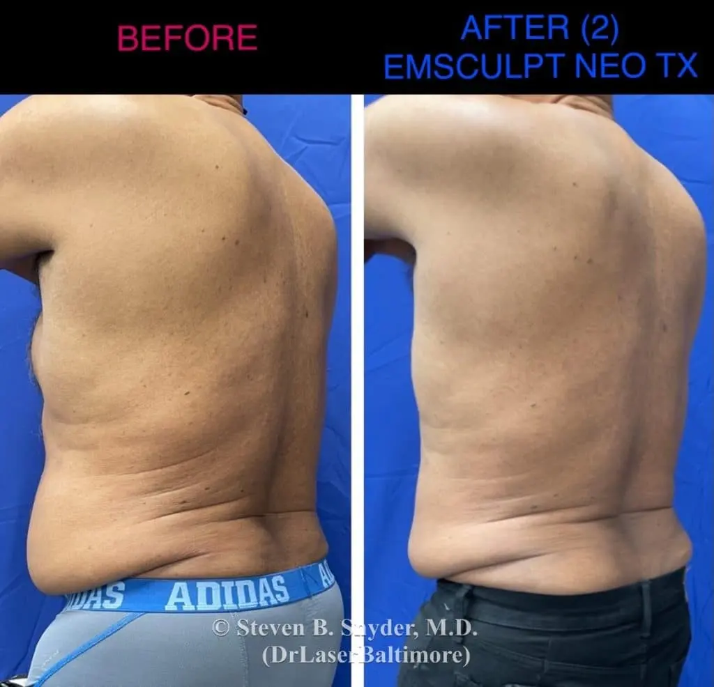 Emsculpt before and after results at Dermatology Laser Center & Medispa, Owings Mills, MD