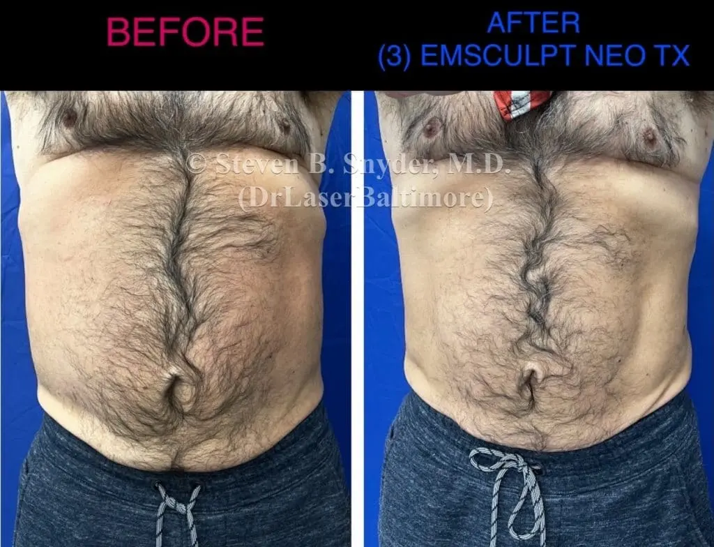 Emsculpt before and after results at Dermatology Laser Center & Medispa, Owings Mills, MD