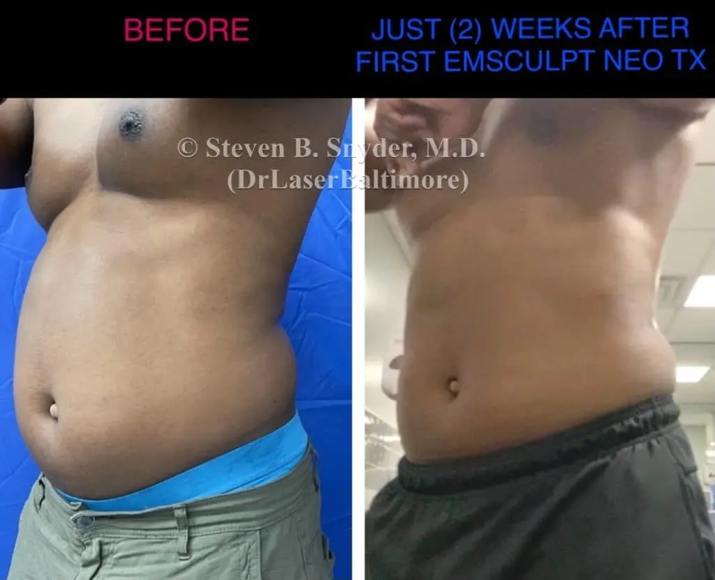 Emsculpt before and after results at Dermatology Laser Center & Medispa, Owings Mills, MD