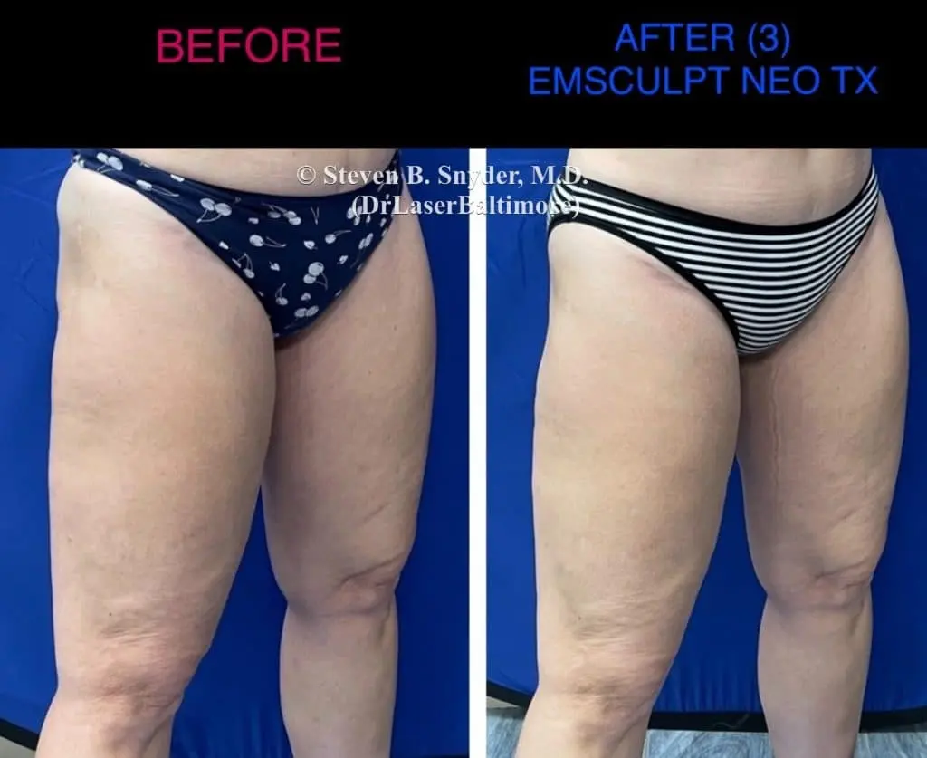 Emsculpt before and after results at Dermatology Laser Center & Medispa, Owings Mills, MD
