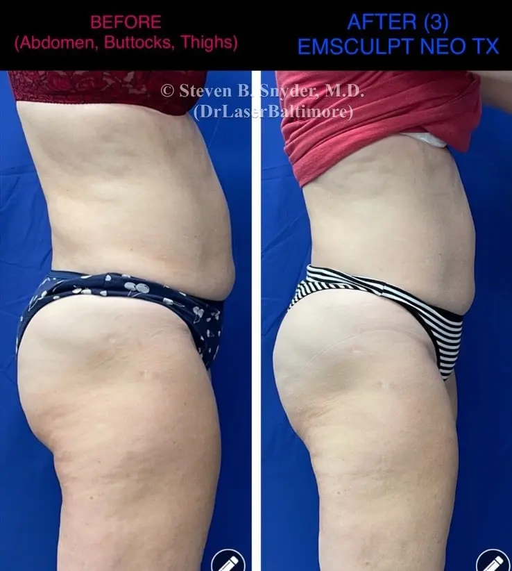 Emsculpt before and after results at Dermatology Laser Center & Medispa, Owings Mills, MD
