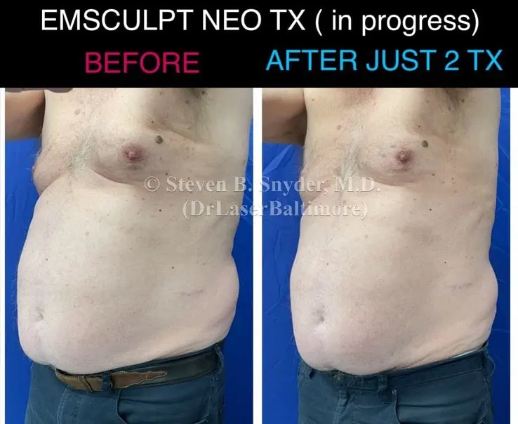 Emsculpt before and after results at Dermatology Laser Center & Medispa, Owings Mills, MD