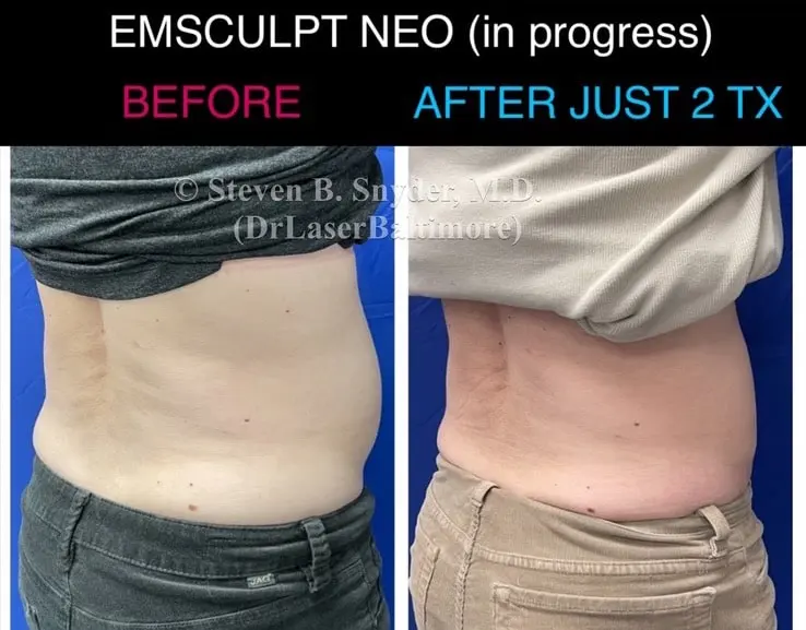 Emsculpt before and after results at Dermatology Laser Center & Medispa, Owings Mills, MD