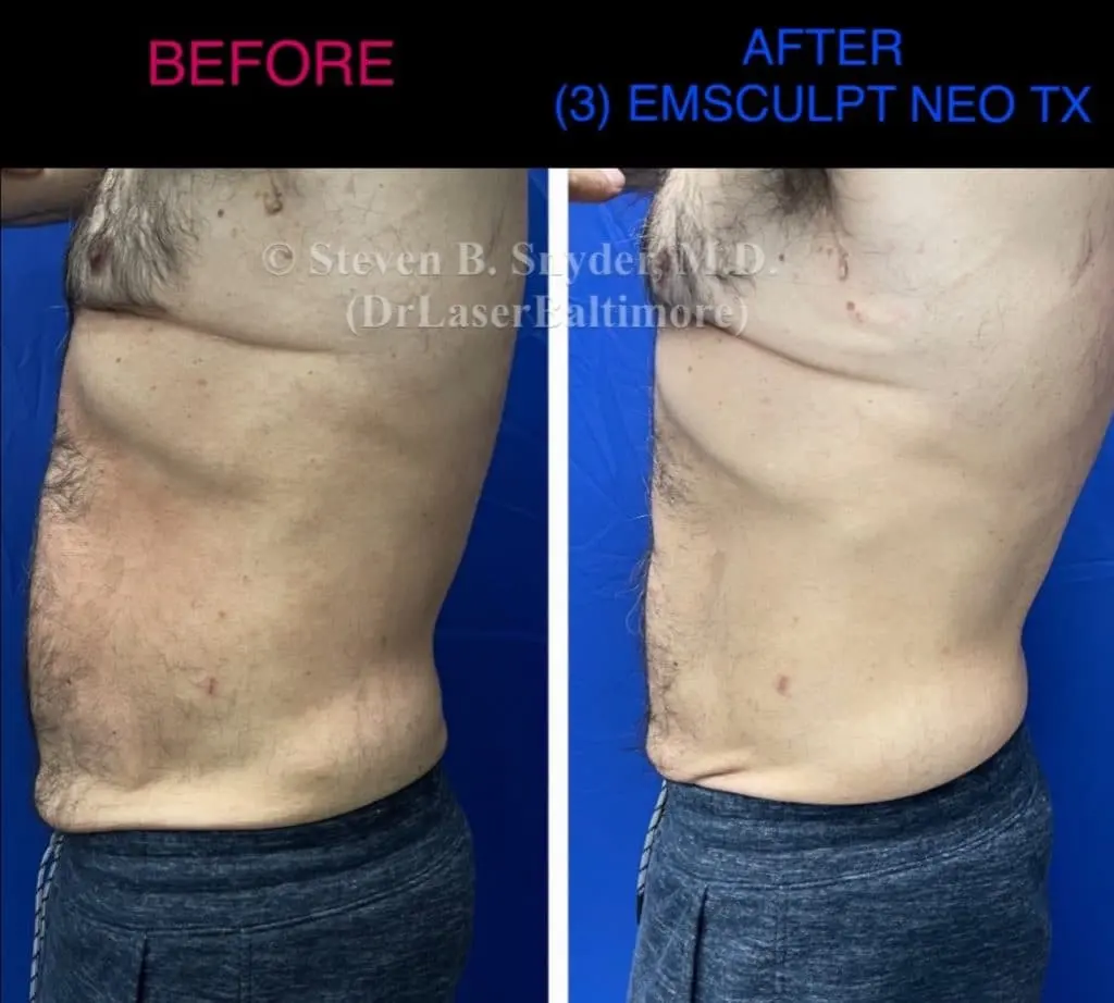 Emsculpt before and after results at Dermatology Laser Center & Medispa, Owings Mills, MD