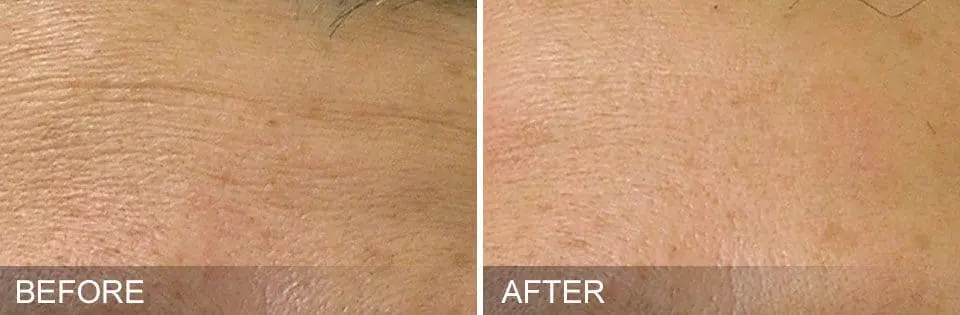 HydraFacial-Before-and-After1