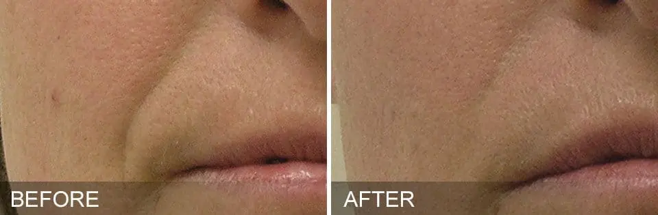 HydraFacial-Before-and-After2