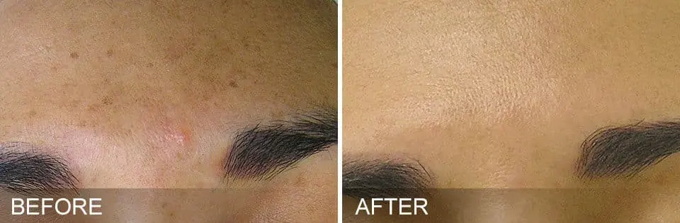 HydraFacial-Before-and-After3