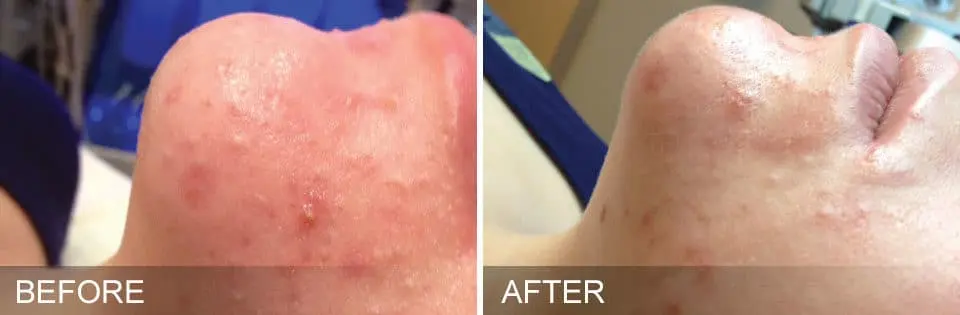 HydraFacial-Before-and-After4