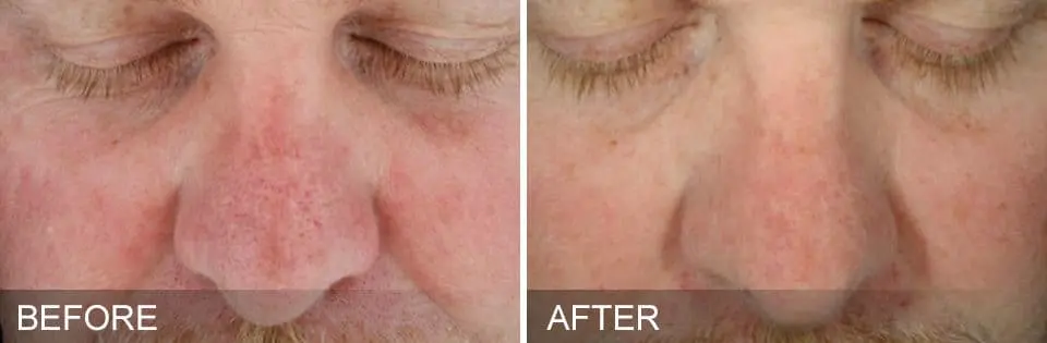 HydraFacial-Before-and-After5