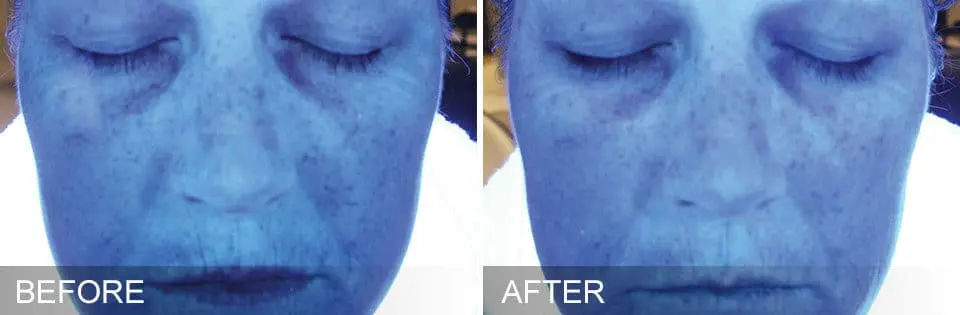 HydraFacial-Before-and-After6