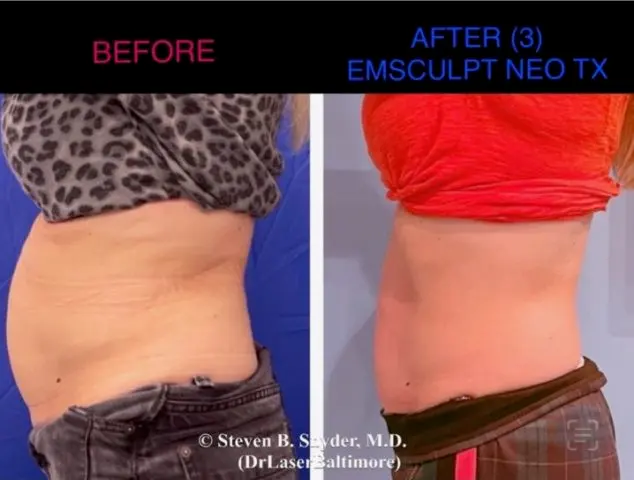Emsculpt NEO Before and After: Real Patient Results — Dermatology Laser Center & Medispa, Owings Mills, MD