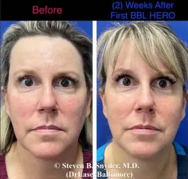 Laser facial before and after result 1 — Dermatology Laser Center & Medispa, Owings Mills, MD