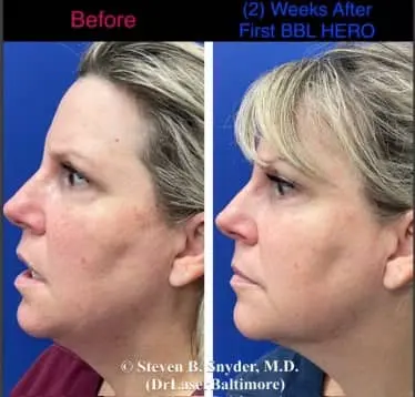 Laser facial before and after result 2 — Dermatology Laser Center & Medispa, Owings Mills, MD