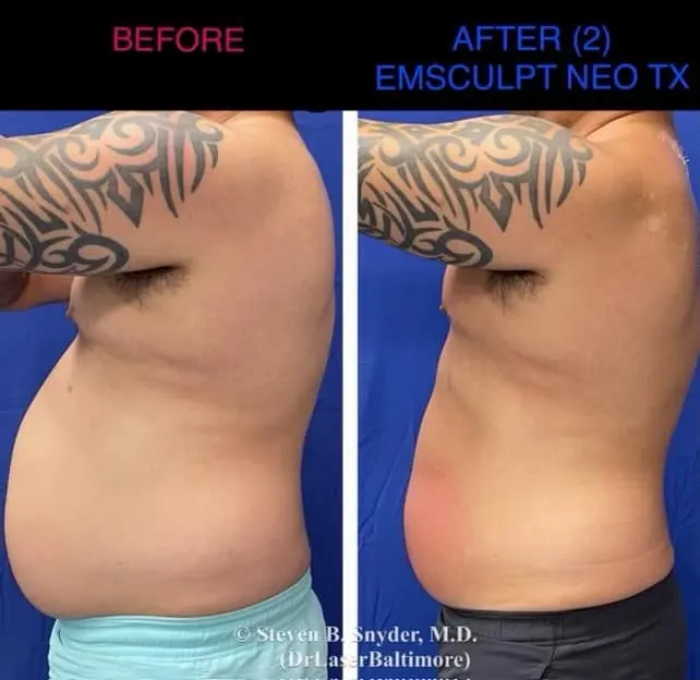 Emsculpt NEO Before and After: Real Patient Results — Dermatology Laser Center & Medispa, Owings Mills, MD