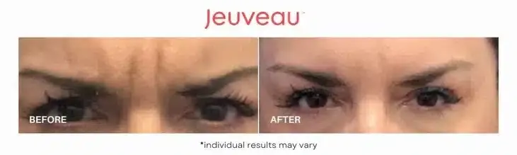 Jeuveau-Before-and-After-1