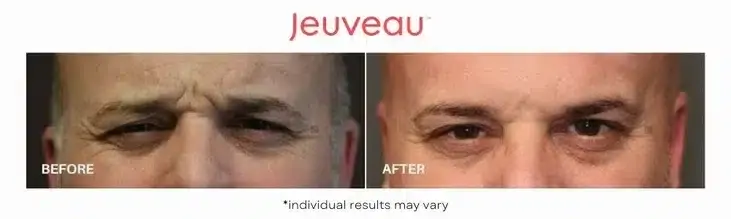 Jeuveau-Before-and-After-2