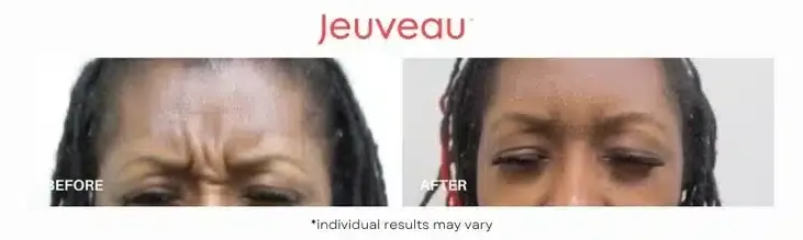 Jeuveau-Before-and-After-3