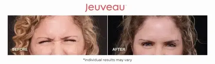 Jeuveau-Before-and-After-4