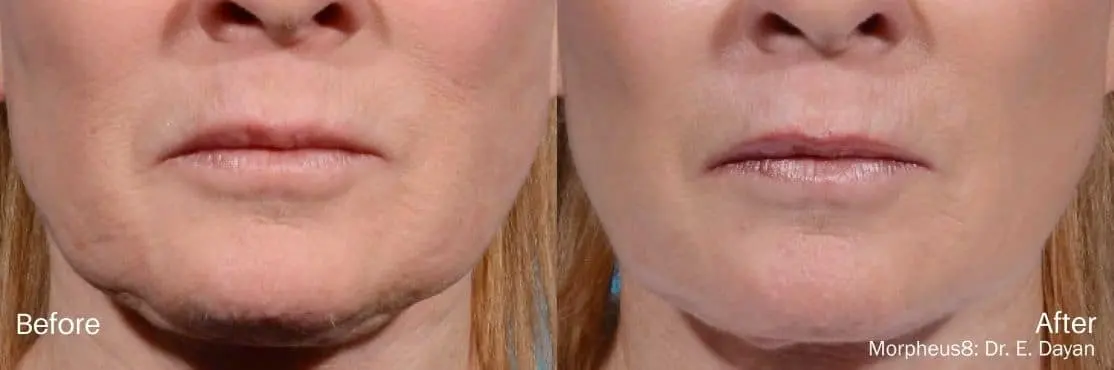 RF-Microneedling-Morpheus8-before-and-after-image-1