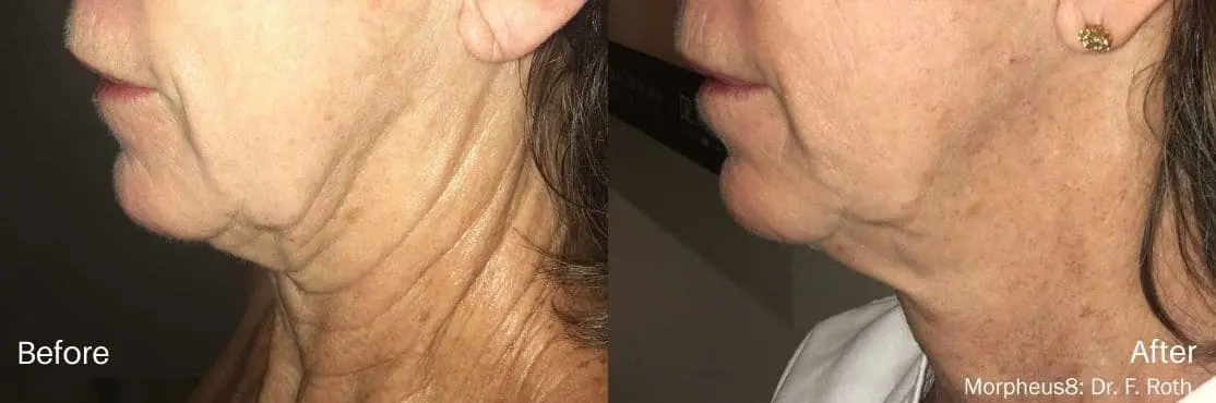 RF-Microneedling-Morpheus8-before-and-after-image-2