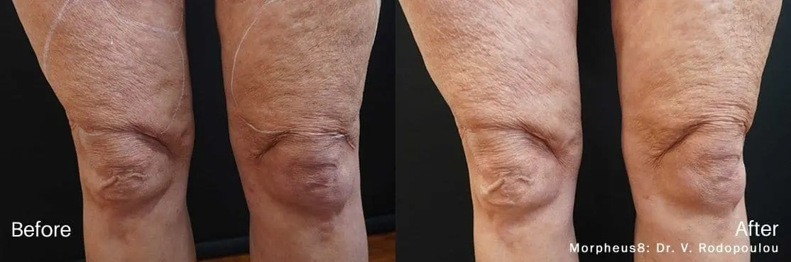 RF-Microneedling-Morpheus8-before-and-after-image-3