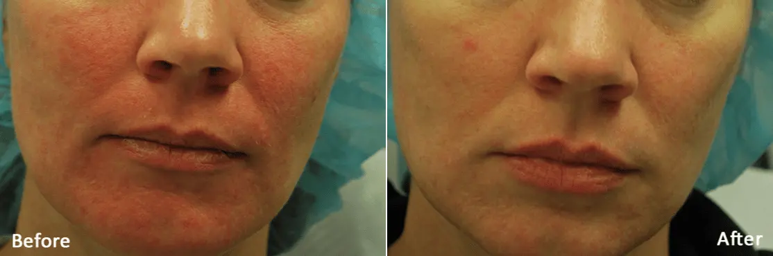 RF-Microneedling-Morpheus8-before-and-after-image-4