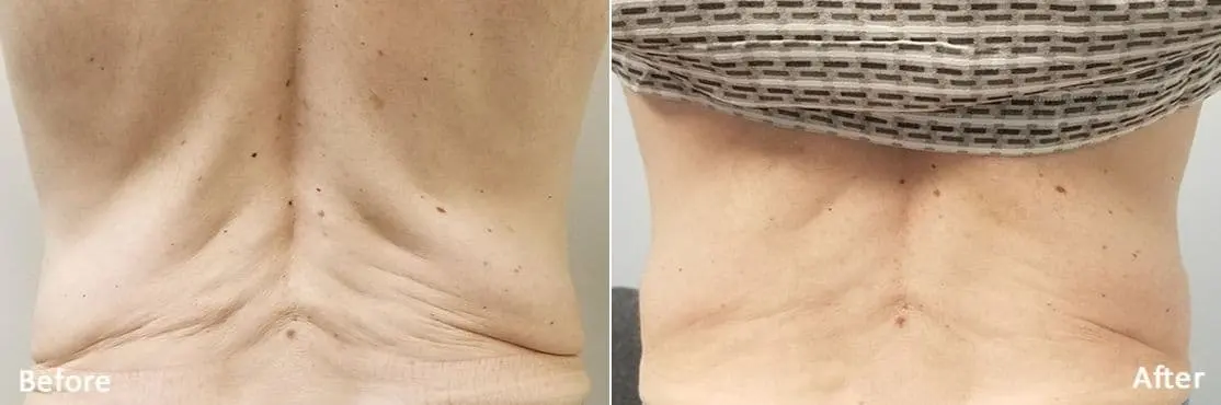RF-Microneedling-Morpheus8-before-and-after-image-5