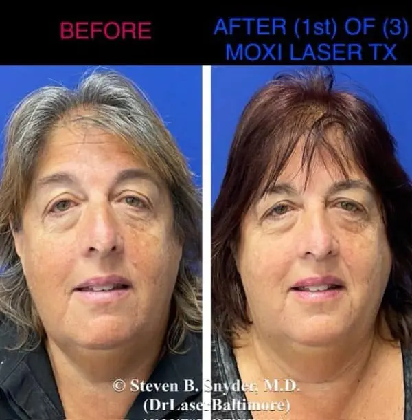 Laser facial before and after result 6 — Dermatology Laser Center & Medispa, Owings Mills, MD